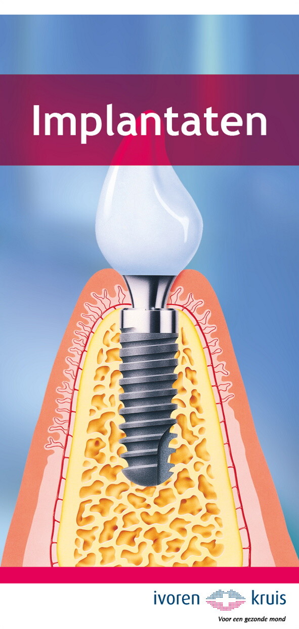 Ivoren Kruis Folder Implantaten